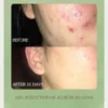 Acne Treatment Skin Care Set Cleansing Acne Face Cleanser Unclog Pores Acid Toner Repairing Cream