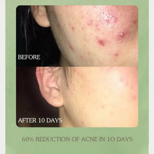 1000016966 Acne Treatment Skin Care Set Cleansing Acne Face Cleanser Unclog Pores Acid Toner Repairing Cream